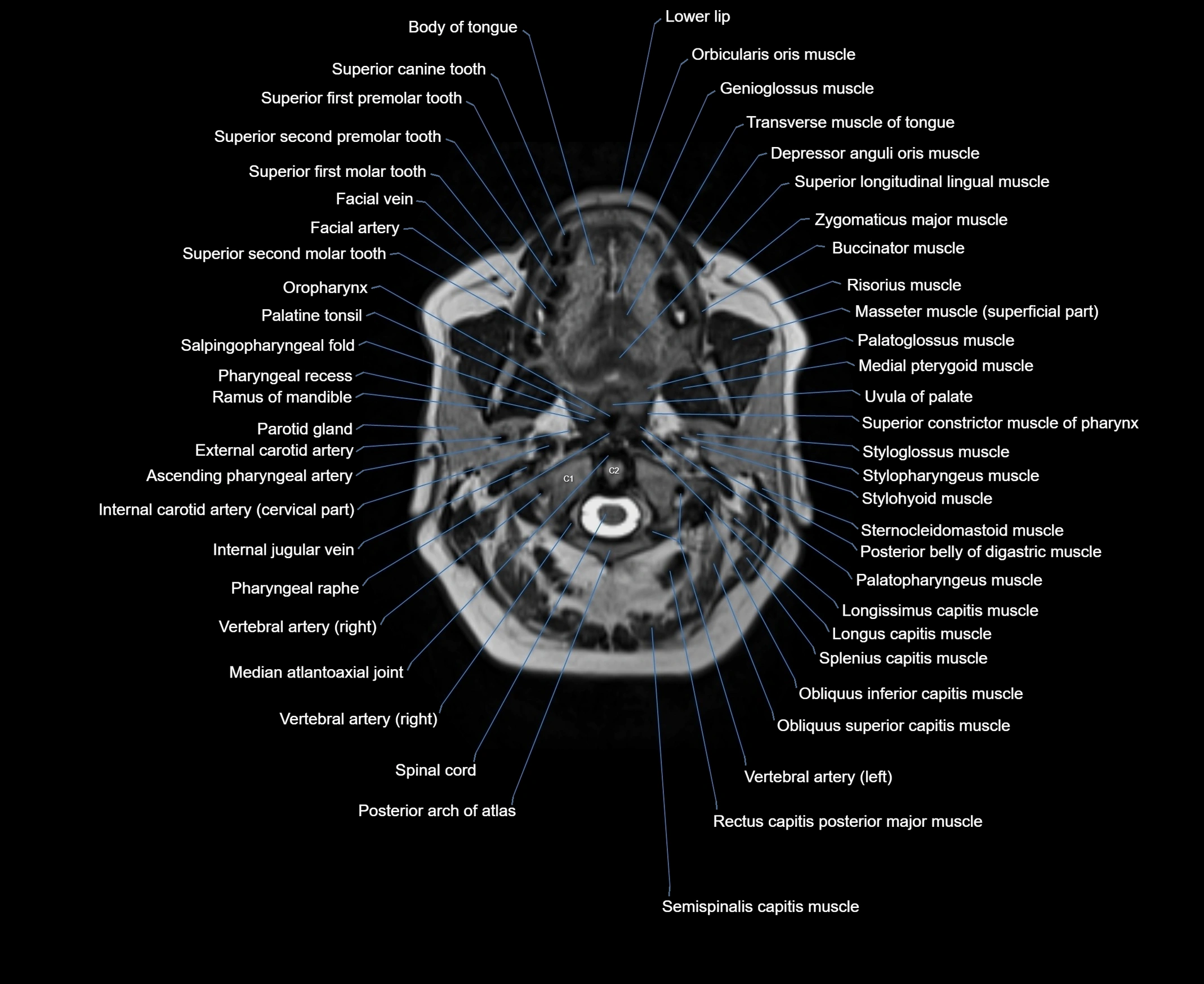 MRI Neck 3D labelled cross section anatomy axial 3t image-00001-00027.webp